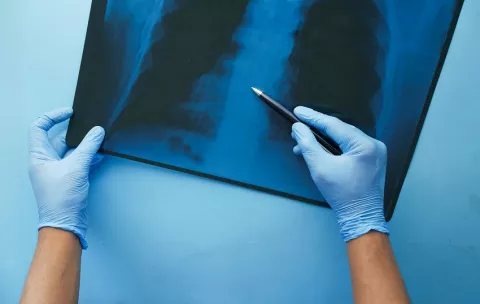 Refuerzan las medidas contra enfermedades respiratorias 