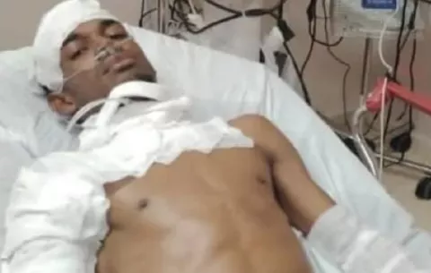 Joven de 28 años sufre quemaduras de segundo grado prendiendo madera