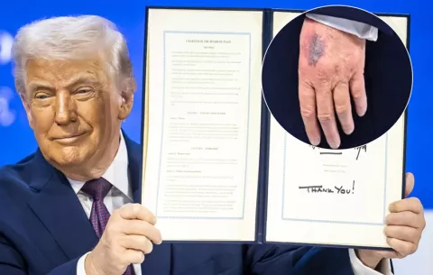 Trump achaca un nuevo moretón en la mano izquierda a un golpe contra una mesa
