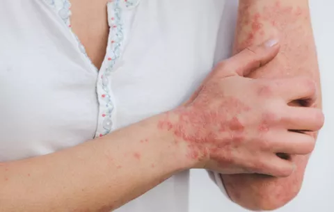 Descubren que un fármaco para la leucemia reduce los síntomas de la psoriasis