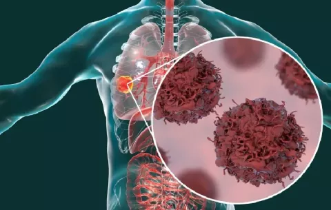 Cáncer de pulmón: prevención y diagnóstico temprano, claves para salvar vidas