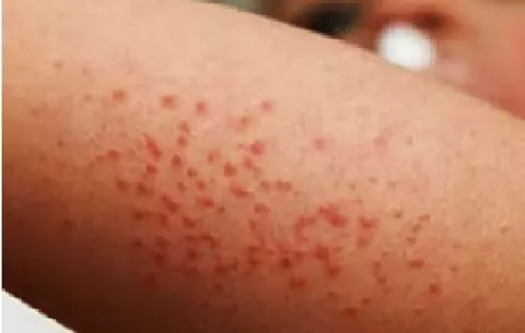 Alerta epidemiológica: Minsa detecta segundo caso de sarampión importado en lo que va del año