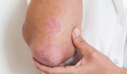 Piden prestar más atención a la psoriasis