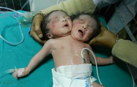 Nace bebé con dos cabezas en India