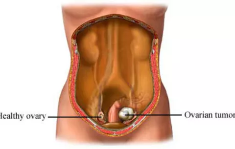  La combinación de dos nuevas moléculas logra frenar mejor el cáncer de ovario