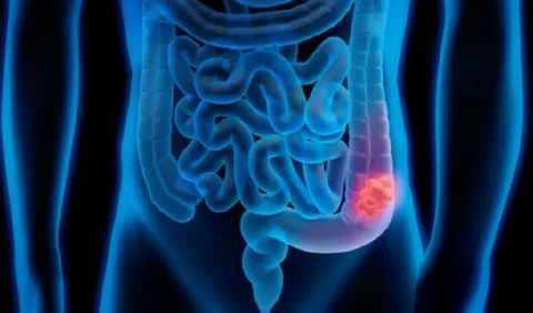 Cáncer colorrectal, más común en ellos