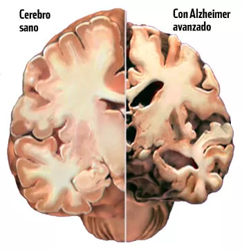 Diseñan molécula que lucha contra el Alzheimer