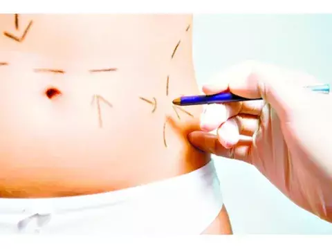 La cirugía de mamas le ha ganado a la liposucción 