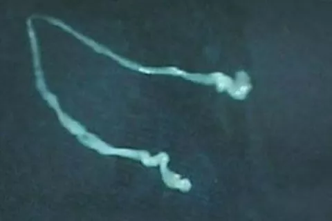 Un hombre vivió con un gusano de 15 centímetros en su cerebro 