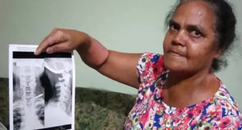 Mujer estuvo 37 años con un trozo de cuchillo clavado en un hombro
