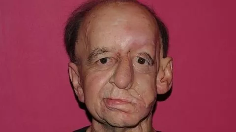 Recobró su rostro gracias a una impresora 3D