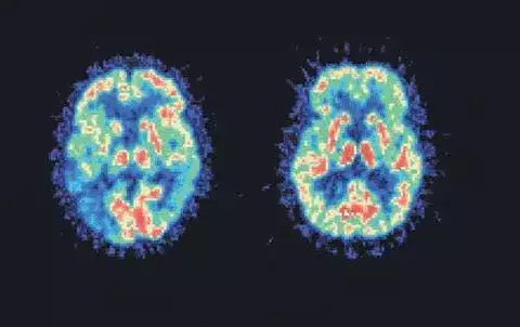 El arte tiene un efecto positivo en los pacientes con Alzheimer 