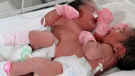 Murieron las hermanas siamesas unidas por el tórax de Paraguay