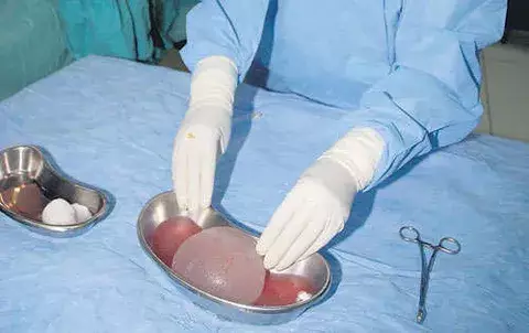 Retiro de implantes de mamas no se recomienda como medida preventiva  