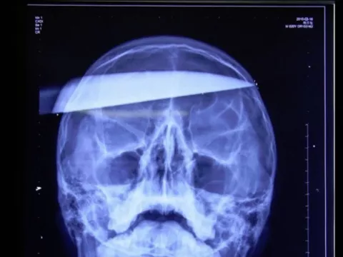 Una joven sobrevive con un cuchillo en la cabeza