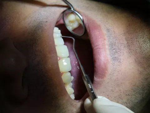 Dentista le borra la sonrisa al sacarle todos los dientes