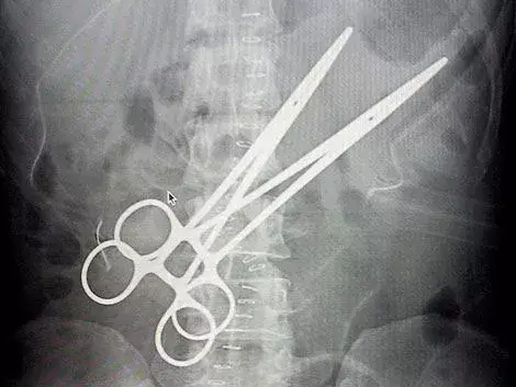 Vivió 16 años con unas pinzas en su abdomen