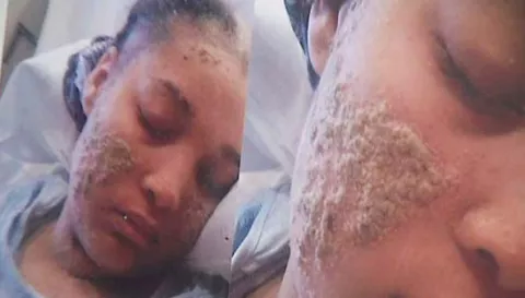 A una mujer le crecen uñas en lugar de cabello