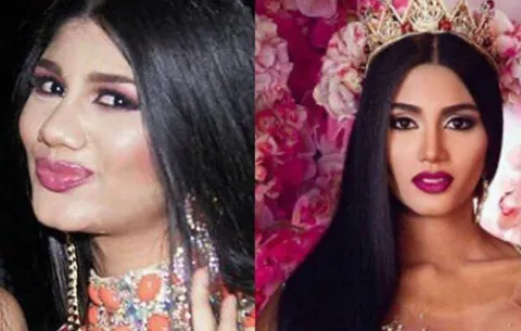 El antes y después de las cirugías de Miss Venezuela