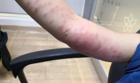 Autoridades de Salud en Chiriquí en alerta por afectaciones en la piel de pelusa de mariposa