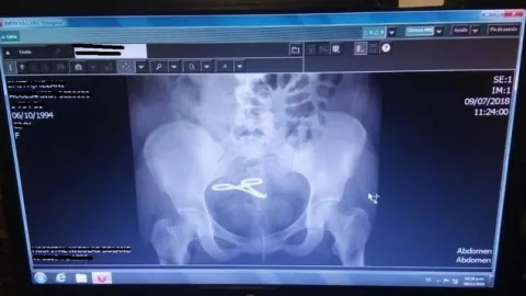 Mujer pierde intestino delgado porque le dejaron una pinza en el vientre en el Santo Tomás