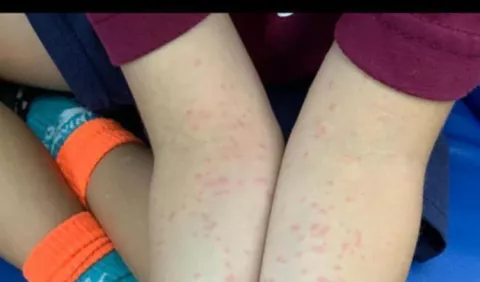 No existe epidemia de Sarna