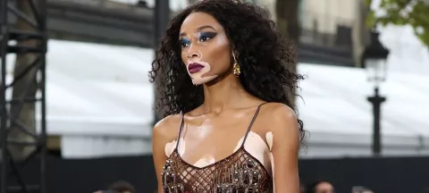 Vitiligo, lucha contra la discriminación 