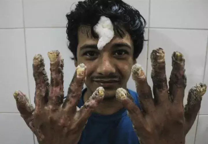 El "hombre árbol" piensa en un futuro como persona normal. Foto/ EFE