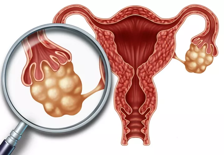 El cáncer de ovario es el séptimo más padecido entre las mujeres en el mundo.