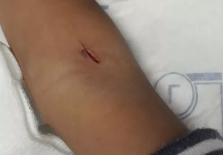 Herida en brazo del niño
