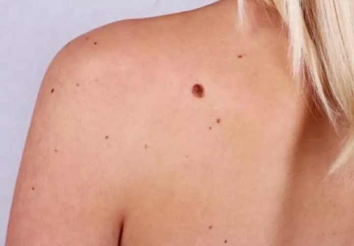 Lo que dispara una mayor probabilidad de padecer melanoma es la exposición crónica al sol.  Pixabay