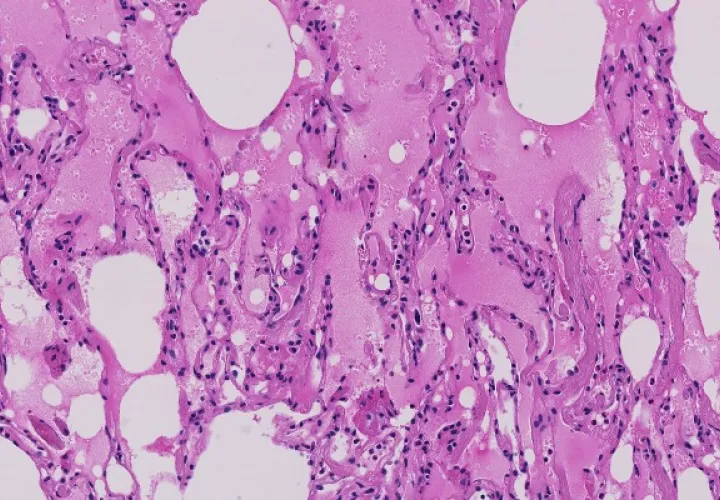 Alveolos pulmonares, llenos de líquido rosa y espeso. Foto / Shu-Yuan Xiao.