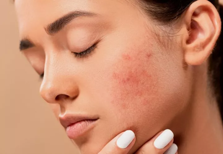 La dermatitis atópica es una deficiencia en la barrera de la piel. Pixabay