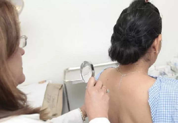 La exposición prolongada al sol es un factor de riesgo del cáncer de piel. Foto: Grupo Epasa