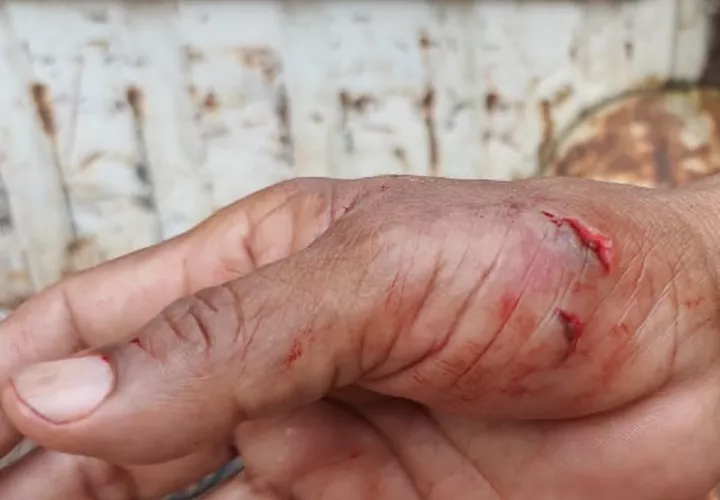 El funcionario de MiAmbiente fue mordido en la mano derecha. Foto: Diómedes Sánchez 