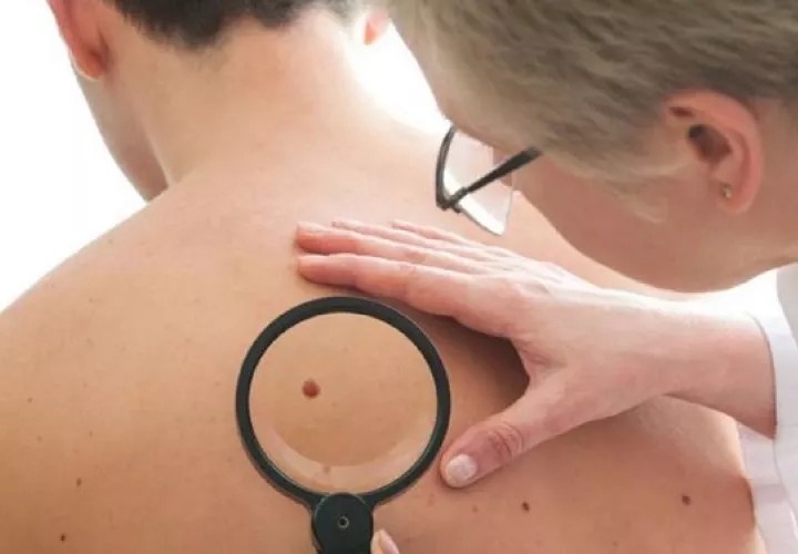 Las tasas de melanoma han aumentado rápidamente en las últimas décadas. Foto: Ilustrativa / Pixabay