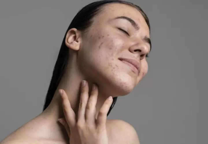 El melasma se produce por el aumento en la producción de melanina. Ilustrativa / Freepik