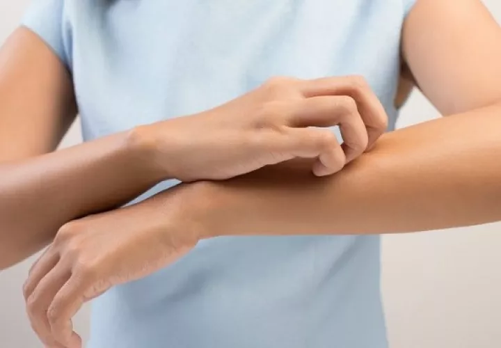 La dermatitis atópica en sus formas más severas hay brotes y erupciones cutáneas impredecibles. Foto: Ilustrativa / Pixabay
