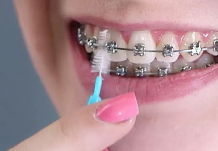 Los 'brackets' son pegados con resina de alta resistencia. Foto:  Ilustrativa / Pixabay