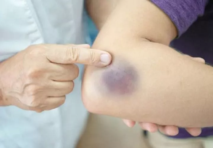 Puede ocasionar hematomas.  Foto: Pixabay / Ilustrativa