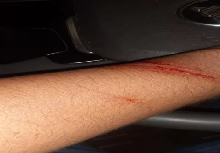 El conductor del vehículo recolector forcejeó,  con su atacante recibiendo una herida en uno de sus brazos y la pierna. Foto: Diomedes Sánchez