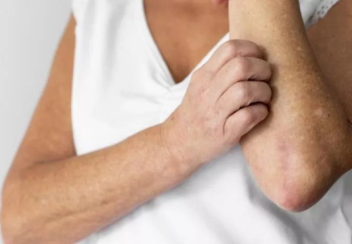 Al igual que la varicela el herpes zóster es causado por el virus varicela-zóster. Foto: Ilustrativa / Freepik
