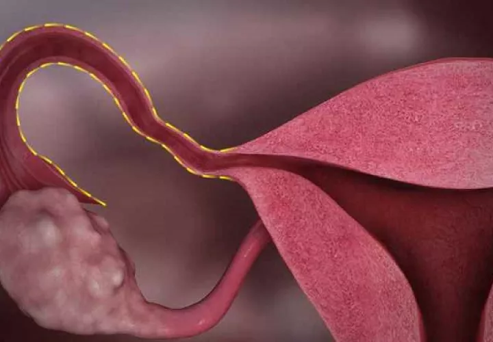 El sangrado vaginal y dolor pélvico son los primeros signos de advertencia. Foto: Ilustrativa / Pixabay