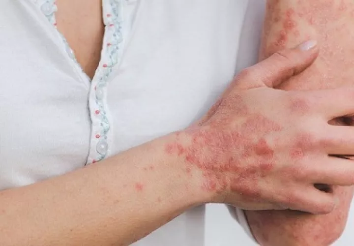 La psoriasis es una enfermedad que se presenta en pa piel, pero que abarca mucho más que eso. Archivo.
