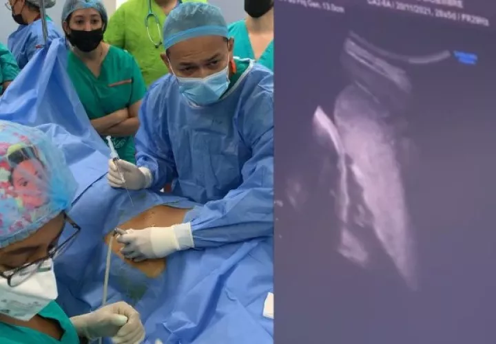 CSS realiza transfusión fetal intrauterina.Foto: Cortesía