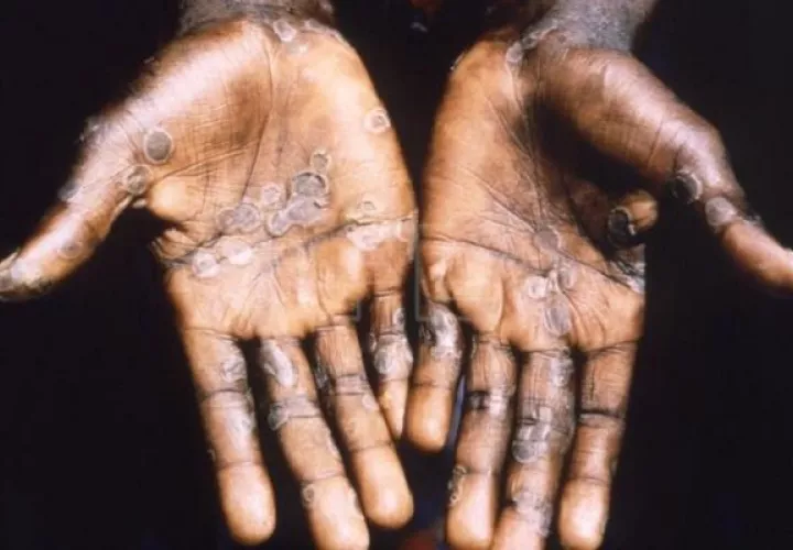 La viruela símica es una enfermedad zoonótica, causada por monkeypox, virus perteneciente al género orthopoxvirus. Foto: EFE