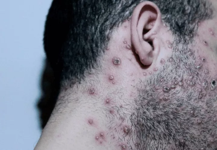 Imagen ilustrativa de un hombre contagiado con la viruela del mono. Foto: Cortesía