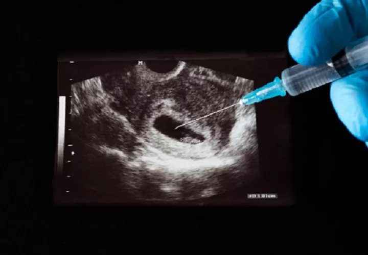 En Panamá se permite el aborto solo por ciertas condiciones médicas y legales. Foto ilustrativa