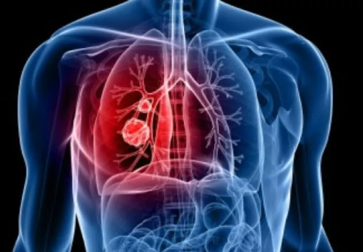 Otra causa de cáncer de pulmón pueden ser el humo de segunda mano. Foto: Pixabay