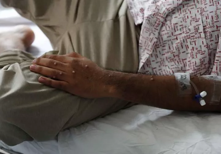  paciente que es atendido tras ser diagnosticado con la viruela del mono, en el hospital Cayatano Heredia, en Lima (Perú). EFE